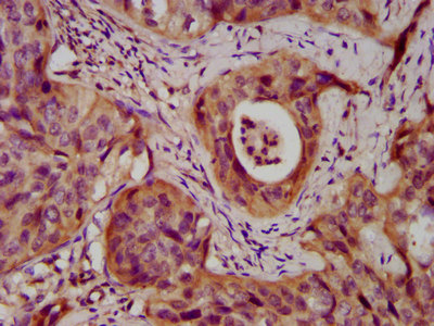 DSC3 / Desmocollin 3 Antibody - Immunohistochemistry image at a dilution of 1:400 and staining in paraffin-embedded human cervical cancer performed on a Leica BondTM system. After dewaxing and hydration, antigen retrieval was mediated by high pressure in a citrate buffer (pH 6.0) . Section was blocked with 10% normal goat serum 30min at RT. Then primary antibody (1% BSA) was incubated at 4 °C overnight. The primary is detected by a biotinylated secondary antibody and visualized using an HRP conjugated SP system.