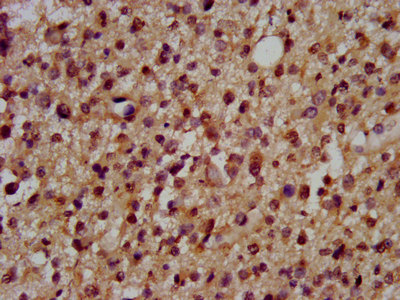 DSCAM Antibody - Immunohistochemistry image at a dilution of 1:200 and staining in paraffin-embedded human glioma cancer performed on a Leica BondTM system. After dewaxing and hydration, antigen retrieval was mediated by high pressure in a citrate buffer (pH 6.0) . Section was blocked with 10% normal goat serum 30min at RT. Then primary antibody (1% BSA) was incubated at 4 °C overnight. The primary is detected by a biotinylated secondary antibody and visualized using an HRP conjugated SP system.