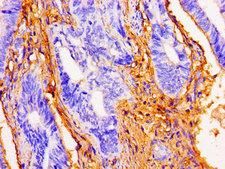 DSG1 / Desmoglein 1 Antibody - Immunohistochemistry image of paraffin-embedded human colon cancer at a dilution of 1:100