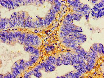 DSG2 / Desmoglein 2 Antibody - Immunohistochemistry image of paraffin-embedded human colon cancer at a dilution of 1:100