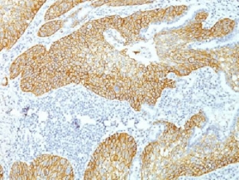 DSG3 / Desmoglein 3 Antibody - IHC testing of FFPE human lung squamos cell carcinoma with Desmoglein 3 antibody (clone DSG3/1535). Required HIER: boil tissue sections in 10mM citrate buffer, pH 6, for 10-20 min.