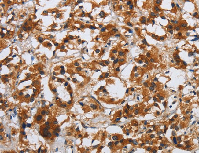 DSP / Desmoplakin Antibody - Immunohistochemistry of paraffin-embedded Human esophagus cancer using DSP Polyclonal Antibody at dilution of 1:40.
