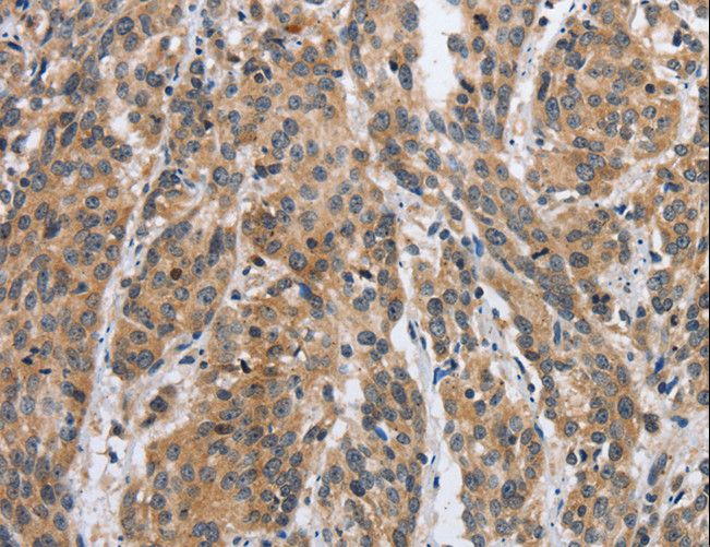 DSP / Desmoplakin Antibody - Immunohistochemistry of paraffin-embedded Human esophagus cancer using DSP Polyclonal Antibody at dilution of 1:40.