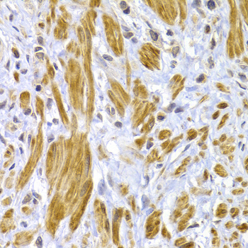 DSP / Desmoplakin Antibody - Immunohistochemistry of paraffin-embedded human gastric cancer using DSP antibody at dilution of 1:100 (40x lens).