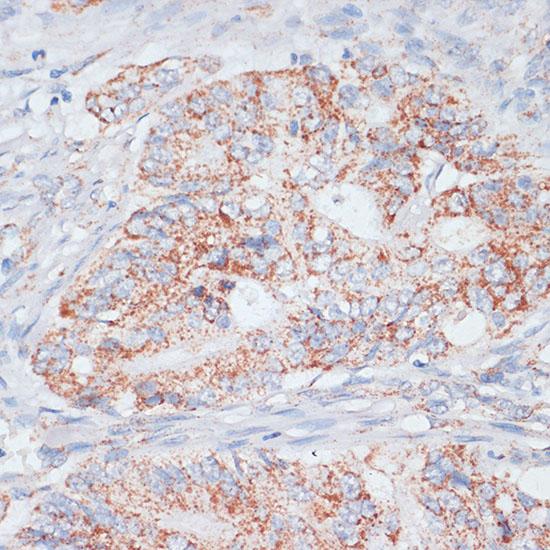 DSP / Desmoplakin Antibody - Immunohistochemistry of paraffin-embedded Human colon carcinoma using Desmoplakin Polyclonal Antibody at dilution of 1:100 (40x lens).