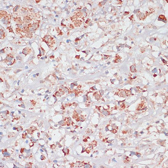 DSP / Desmoplakin Antibody - Immunohistochemistry of paraffin-embedded Human breast cancer using Desmoplakin Polyclonal Antibody at dilution of 1:100 (40x lens).