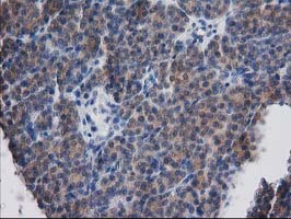 DSTN / Destrin Antibody - IHC of paraffin-embedded Carcinoma of Human thyroid tissue using anti-DSTN mouse monoclonal antibody. (Heat-induced epitope retrieval by 10mM citric buffer, pH6.0, 100C for 10min).