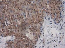 DSTN / Destrin Antibody - IHC of paraffin-embedded Adenocarcinoma of Human breast tissue using anti-DSTN mouse monoclonal antibody. (Heat-induced epitope retrieval by 10mM citric buffer, pH6.0, 100C for 10min).
