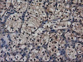 DSTN / Destrin Antibody - IHC of paraffin-embedded Carcinoma of Human kidney tissue using anti-DSTN mouse monoclonal antibody. (Heat-induced epitope retrieval by 10mM citric buffer, pH6.0, 100C for 10min).