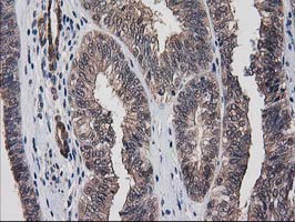 DSTN / Destrin Antibody - IHC of paraffin-embedded Adenocarcinoma of Human endometrium tissue using anti-DSTN mouse monoclonal antibody. (Heat-induced epitope retrieval by 10mM citric buffer, pH6.0, 100C for 10min).