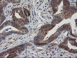 DSTN / Destrin Antibody - IHC of paraffin-embedded Adenocarcinoma of Human colon tissue using anti-DSTN mouse monoclonal antibody.
