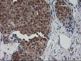 DSTN / Destrin Antibody - IHC of paraffin-embedded Adenocarcinoma of Human breast tissue using anti-DSTN mouse monoclonal antibody.