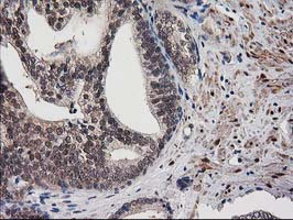 DSTN / Destrin Antibody - IHC of paraffin-embedded Carcinoma of Human prostate tissue using anti-DSTN mouse monoclonal antibody.