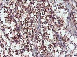DSTN / Destrin Antibody - IHC of paraffin-embedded Carcinoma of Human kidney tissue using anti-DSTN mouse monoclonal antibody.