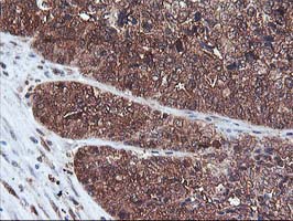 DSTN / Destrin Antibody - IHC of paraffin-embedded Adenocarcinoma of Human ovary tissue using anti-DSTN mouse monoclonal antibody.