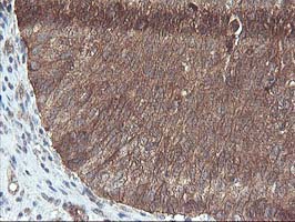 DSTN / Destrin Antibody - IHC of paraffin-embedded Carcinoma of Human bladder tissue using anti-DSTN mouse monoclonal antibody.