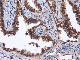 DSTN / Destrin Antibody - IHC of paraffin-embedded Carcinoma of Human lung tissue using anti-DSTN mouse monoclonal antibody.
