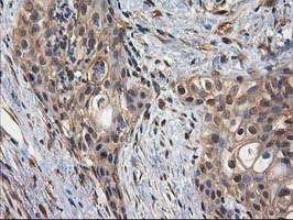 DSTN / Destrin Antibody - IHC of paraffin-embedded Carcinoma of Human pancreas tissue using anti-DSTN mouse monoclonal antibody.