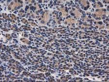 DSTN / Destrin Antibody - IHC of paraffin-embedded Carcinoma of Human thyroid tissue using anti-DSTN mouse monoclonal antibody.