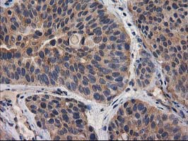 DSTN / Destrin Antibody - IHC of paraffin-embedded Carcinoma of Human bladder tissue using anti-DSTN mouse monoclonal antibody.