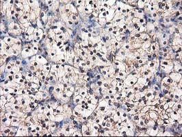 DSTN / Destrin Antibody - IHC of paraffin-embedded Carcinoma of Human kidney tissue using anti-DSTN mouse monoclonal antibody.