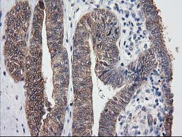 DSTN / Destrin Antibody - IHC of paraffin-embedded Adenocarcinoma of Human endometrium tissue using anti-DSTN mouse monoclonal antibody.