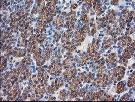 DSTN / Destrin Antibody - IHC of paraffin-embedded Carcinoma of Human thyroid tissue using anti-DSTN mouse monoclonal antibody.