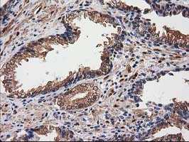 DSTN / Destrin Antibody - IHC of paraffin-embedded Carcinoma of Human prostate tissue using anti-DSTN mouse monoclonal antibody.