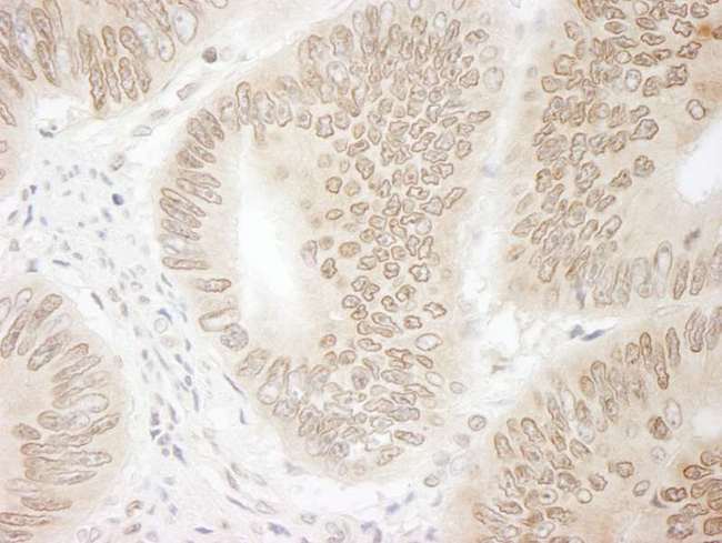 DTL / CDT2 Antibody - Detection of Human DTL/CDT2 by Immunohistochemistry. Sample: FFPE section of human colon carcinoma. Antibody: Affinity purified rabbit anti-DTL/CDT2 used at a dilution of 1:250. Epitope Retrieval Buffer-High pH (IHC-101J) was substituted for Epitope Retrieval Buffer-Reduced pH.