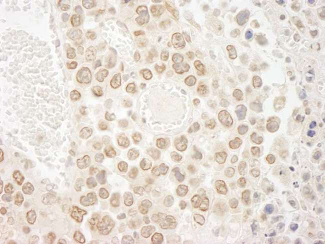 DTL / CDT2 Antibody - Detection of Mouse DTL/CDT2 by Immunohistochemistry. Sample: FFPE section of mouse hybridoma tumor. Antibody: Affinity purified rabbit anti-DTL/CDT2 used at a dilution of 1:250. Epitope Retrieval Buffer-High pH (IHC-101J) was substituted for Epitope Retrieval Buffer-Reduced pH.