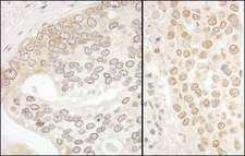 DTL / CDT2 Antibody - Detection of Human and Mouse DTL/CDT2 by Immunohistochemistry. Sample: FFPE section of human colon carcinoma (left) and mouse hybridoma tumor (right). Antibody: Affinity purified rabbit anti-DTL/CDT2 used at a dilution of 1:1000 (1 Detection: DAB.