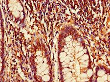 DTL / CDT2 Antibody - Immunohistochemistry of paraffin-embedded human colon cancer using DTL Antibody at dilution of 1:100