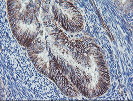DTNB / Dystrobrevin Beta Antibody - IHC of paraffin-embedded Adenocarcinoma of Human endometrium tissue using anti-DTNB mouse monoclonal antibody.