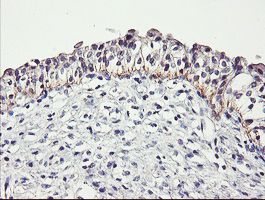DTNB / Dystrobrevin Beta Antibody - IHC of paraffin-embedded Carcinoma of Human bladder tissue using anti-DTNB mouse monoclonal antibody.