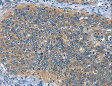 DTX1 / Deltex Antibody - Immunohistochemistry of paraffin-embedded Human thyroid cancer using DTX1 Polyclonal Antibody at dilution of 1:30.