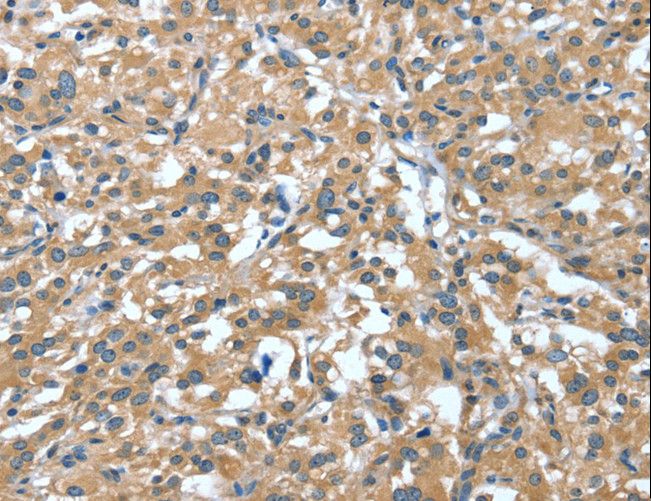 DTX1 / Deltex Antibody - Immunohistochemistry of paraffin-embedded Human thyroid cancer using DTX1 Polyclonal Antibody at dilution of 1:30.