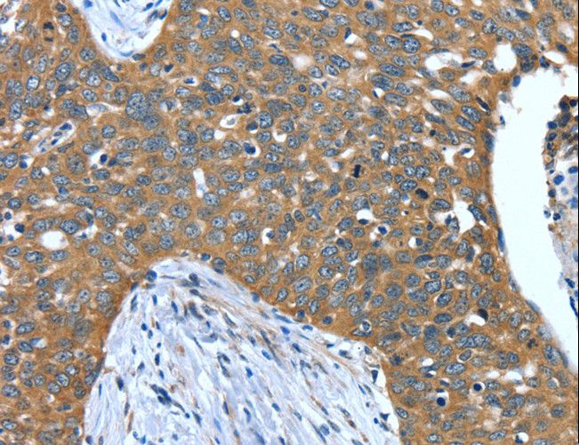 DTX1 / Deltex Antibody - Immunohistochemistry of paraffin-embedded Human gastric cancer using DTX1 Polyclonal Antibody at dilution of 1:40.