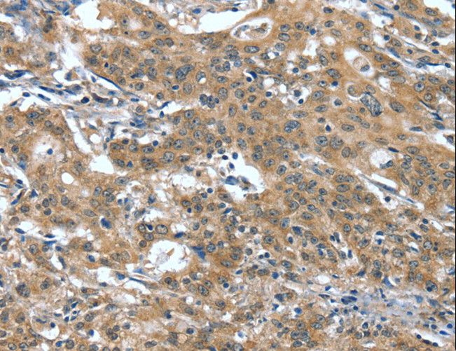 DTX1 / Deltex Antibody - Immunohistochemistry of paraffin-embedded Human gastric cancer using DTX1 Polyclonal Antibody at dilution of 1:40.
