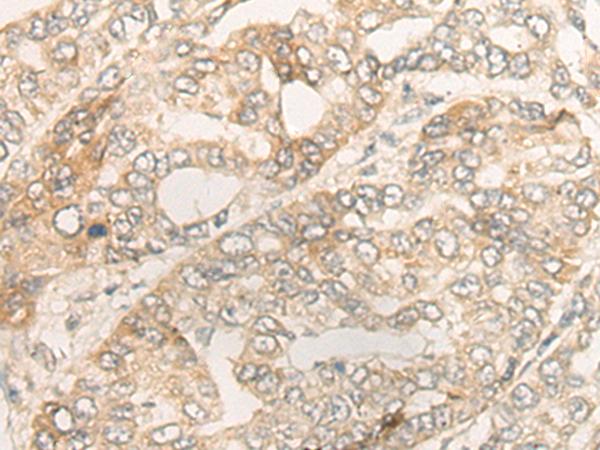 DUOX2 Antibody - Immunohistochemistry of paraffin-embedded Human liver cancer tissue  using DUOX2 Polyclonal Antibody at dilution of 1:40(×200)
