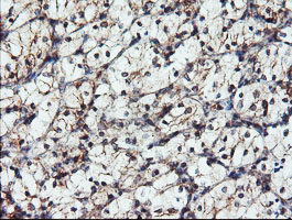 DUPD1 Antibody - IHC of paraffin-embedded Carcinoma of Human kidney tissue using anti-DUPD1 mouse monoclonal antibody.