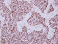 DUS2 / DUS2L Antibody - IHC of paraffin-embedded Lung ca, using DUS2L antibody at 1:500 dilution.