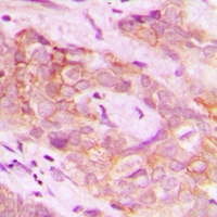 DUS2 / DUS2L Antibody - Immunohistochemical analysis of DUS2L staining in human breast cancer formalin fixed paraffin embedded tissue section. The section was pre-treated using heat mediated antigen retrieval with sodium citrate buffer (pH 6.0). The section was then incubated with the antibody at room temperature and detected using an HRP conjugated compact polymer system. DAB was used as the chromogen. The section was then counterstained with haematoxylin and mounted with DPX.