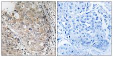 DUSP1 + DUSP4 Antibody - Immunohistochemistry analysis of paraffin-embedded human breast carcinoma tissue, using MKP-1/2 Antibody. The picture on the right is blocked with the synthesized peptide.