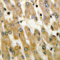 DUSP1 + DUSP4 Antibody - Immunohistochemical analysis of DUSP1/4 staining in human liver cancer formalin fixed paraffin embedded tissue section. The section was pre-treated using heat mediated antigen retrieval with sodium citrate buffer (pH 6.0). The section was then incubated with the antibody at room temperature and detected using an HRP conjugated compact polymer system. DAB was used as the chromogen. The section was then counterstained with hematoxylin and mounted with DPX.