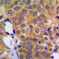 DUSP1 / MKP1 Antibody - Immunohistochemical analysis of DUSP1 staining in human prostate cancer formalin fixed paraffin embedded tissue section. The section was pre-treated using heat mediated antigen retrieval with sodium citrate buffer (pH 6.0). The section was then incubated with the antibody at room temperature and detected using an HRP conjugated compact polymer system. DAB was used as the chromogen. The section was then counterstained with hematoxylin and mounted with DPX.