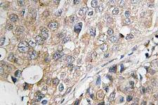 DUSP1 / MKP1 Antibody - IHC of MKP-1/2 (Q290) pAb in paraffin-embedded human breast carcinoma tissue.