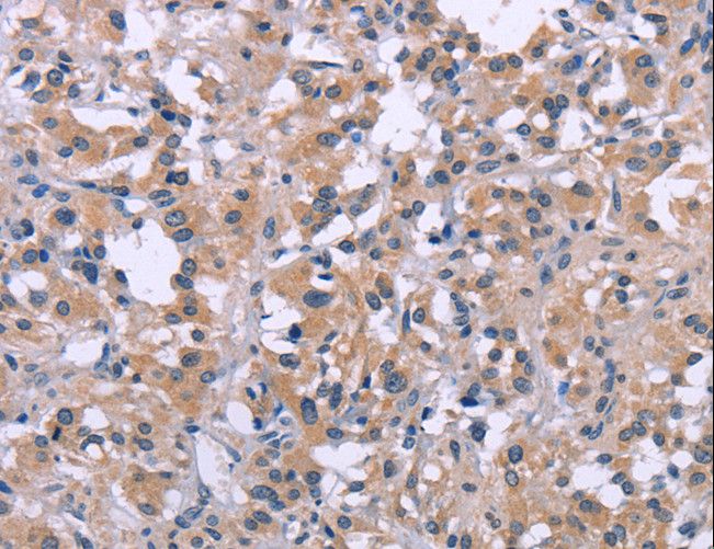 DUSP1 / MKP1 Antibody - Immunohistochemistry of paraffin-embedded Human thyroid cancer using DUSP1 Polyclonal Antibody at dilution of 1:30.