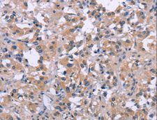DUSP1 / MKP1 Antibody - Immunohistochemistry of paraffin-embedded Human thyroid cancer using DUSP1 Polyclonal Antibody at dilution of 1:30.