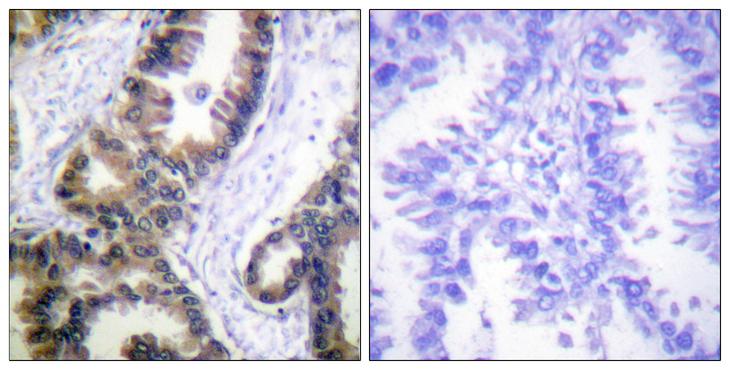 DUSP1 / MKP1 Antibody - Peptide - + Immunohistochemistry analysis of paraffin-embedded human lung carcinoma tissue using MKP1 (Ab-359) antibody.