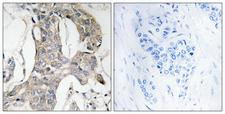 DUSP1 / MKP1 Antibody - Immunohistochemistry analysis of paraffin-embedded human breast carcinoma, using MKP-1/2 (Phospho-Ser296/318) Antibody. The picture on the right is blocked with the phospho peptide.